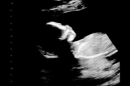 Is A Clear Discharge A Sign Of Pregnancy