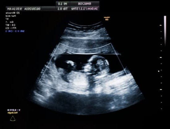 How Do Early Pregnancy Discharge Look