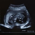 When Does Pregnancy Start When does pregnancy start - An embryo forms when sperm fertilizes an egg